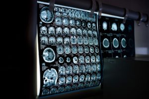 MRI Scan